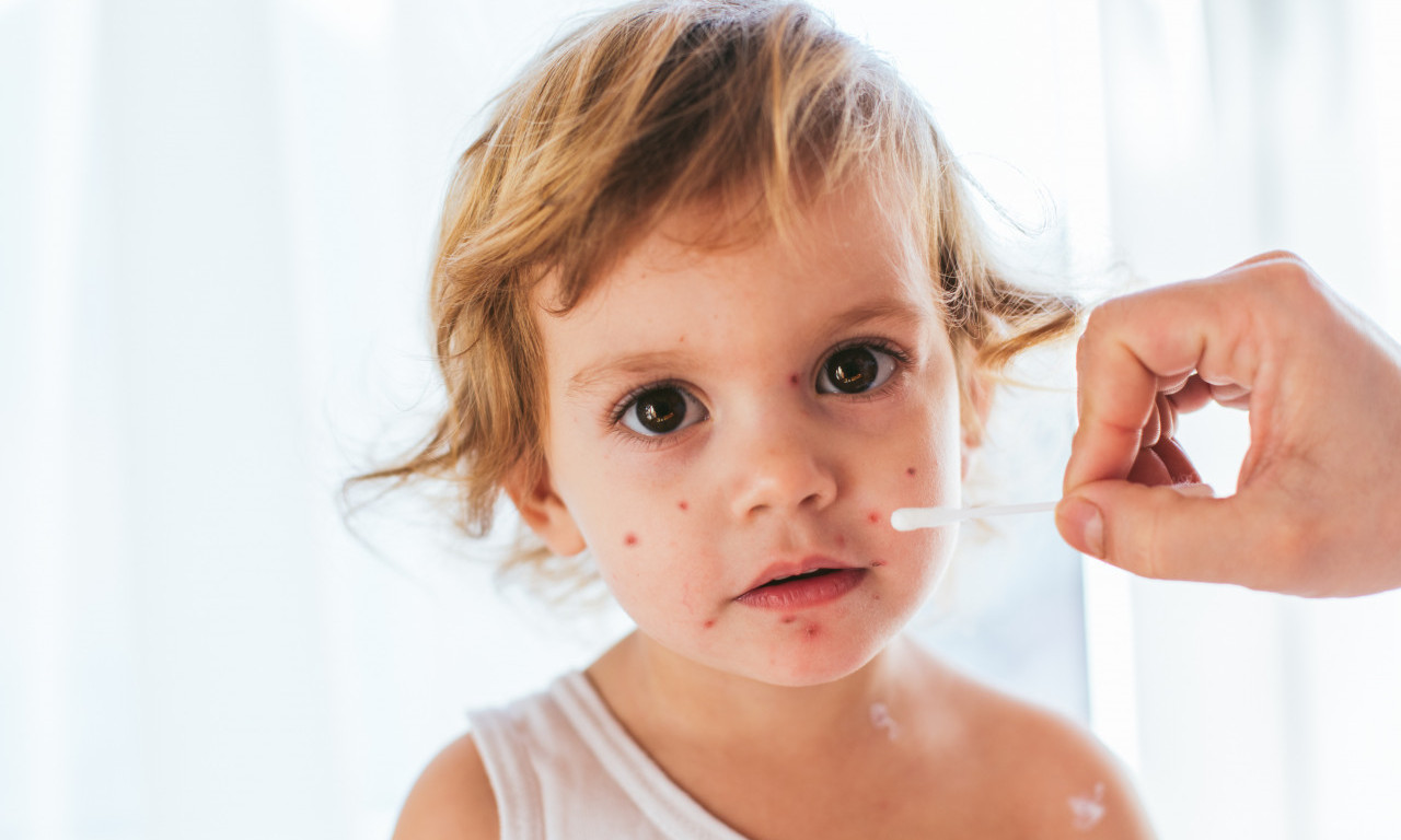 Potvrđena PORODIČNA EPIDEMIJA u Nišu! Širi se zaraza MALIH BOGINJA, među obolelima i BEBE