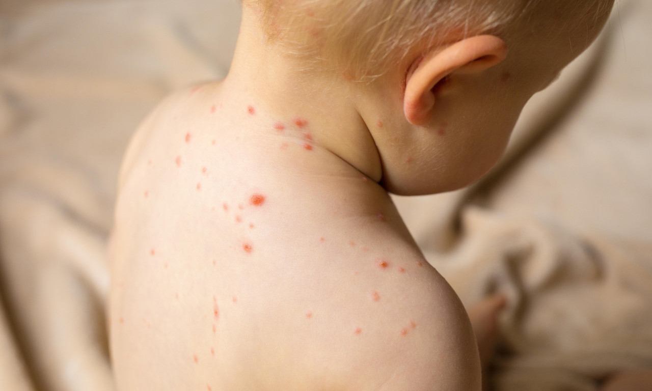 PREMINULO DETE OD MALIH BOGINJA Epidemija puni bolnice! Najugroženiji su mališani